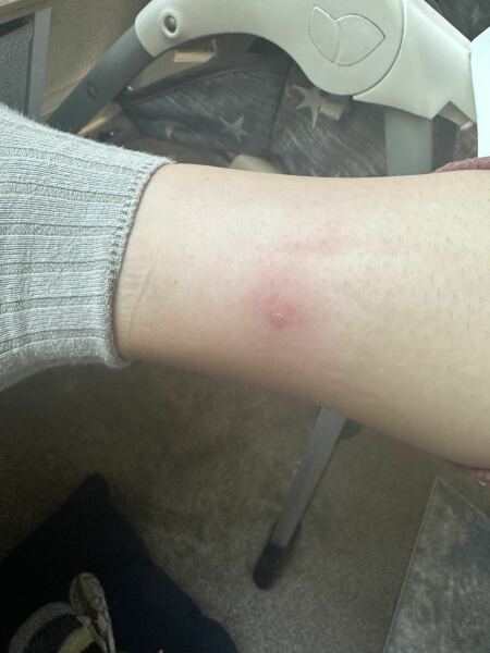 Horsefly bite or just a mozzie ?