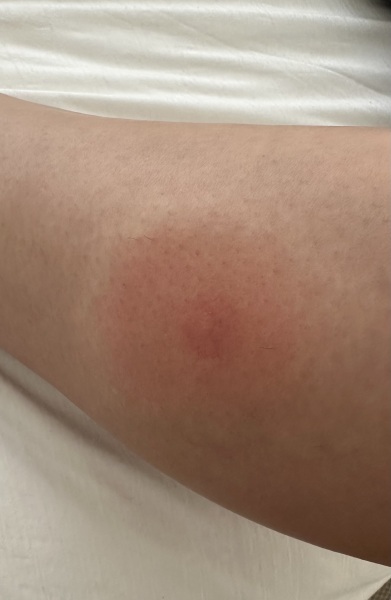 Is this a bullseye rash?