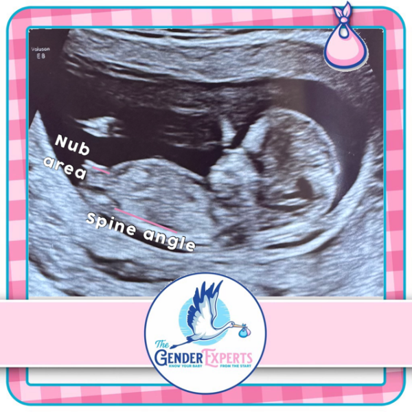 Umbilical cord or boy?