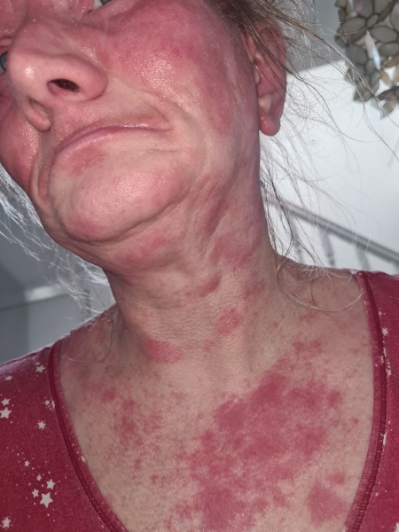 Immunosupressant Abrocitinib