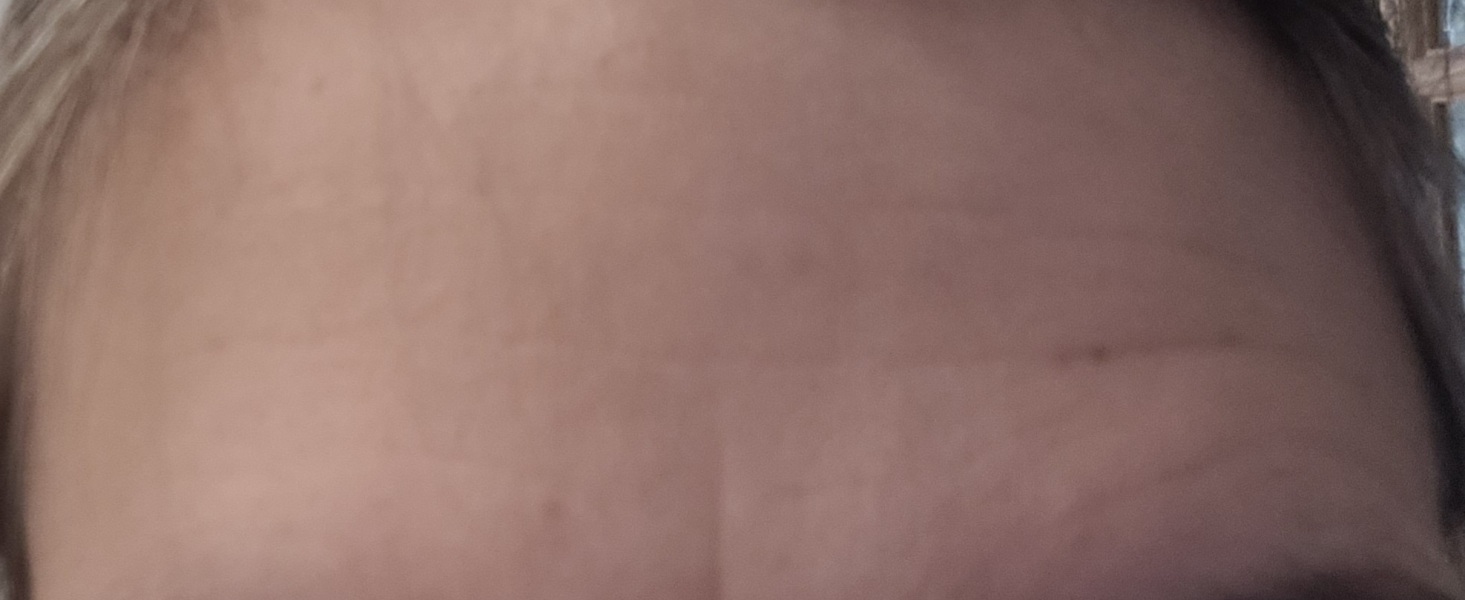 Can you see forehead wrinkle difference?