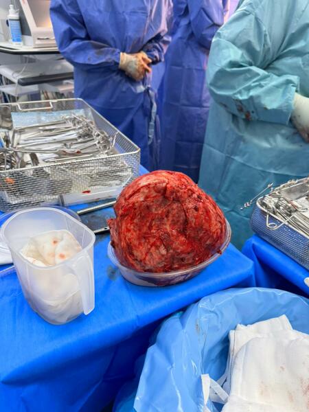 Fibroids during pregnancy