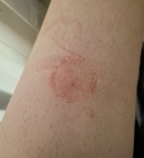 Do you want to see something *disgusting* on my leg?