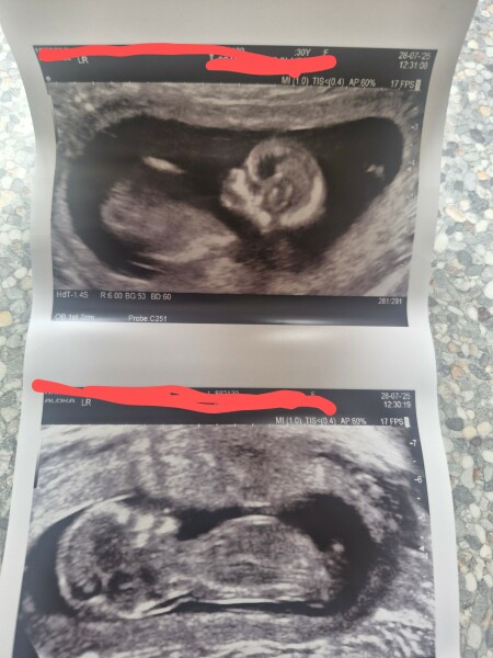 Boy or girl, nub theory!