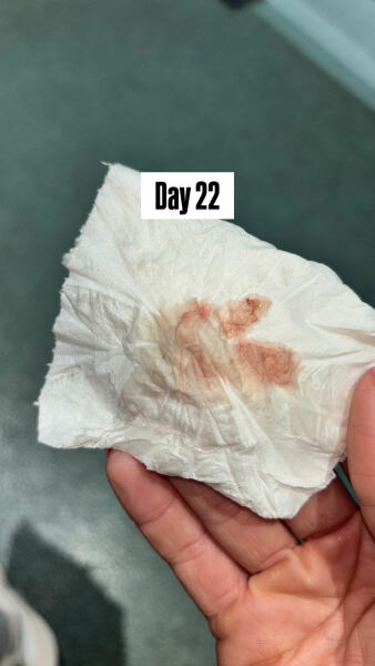 8DPO… anyone else!