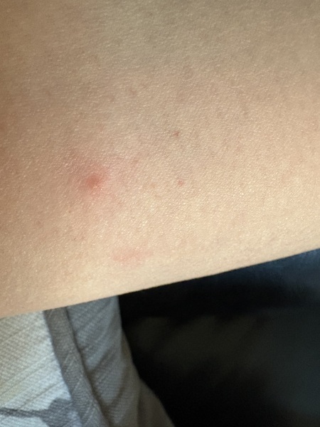 Itchy spots