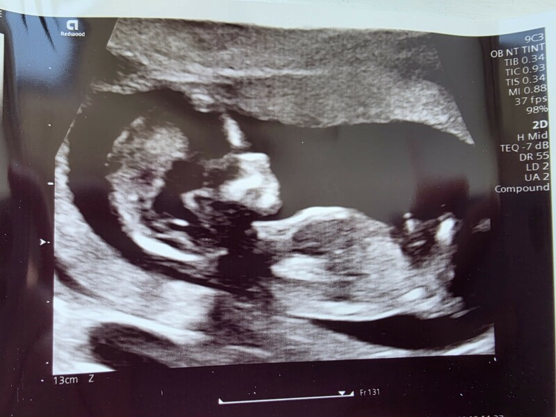 Is there a nub on this scan pic?