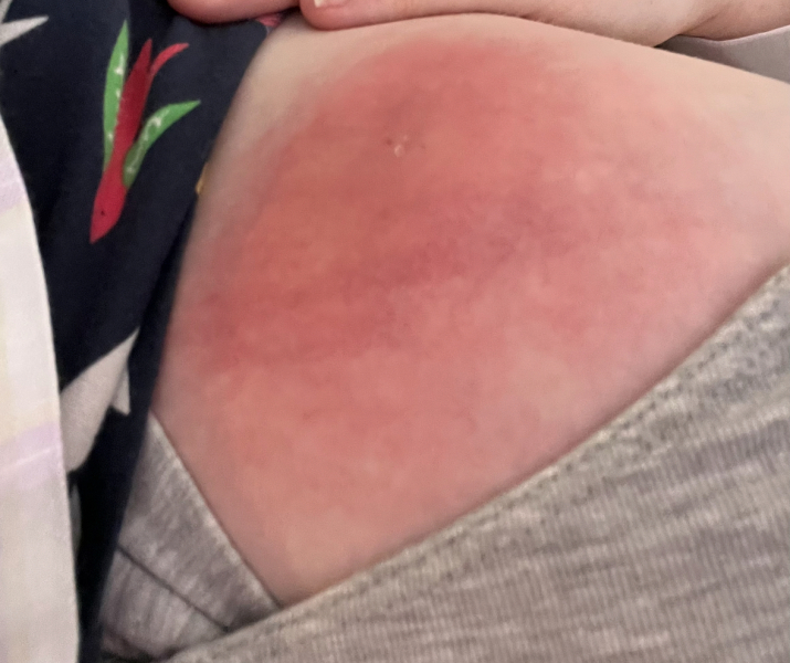 Mastitis- please please any advice?