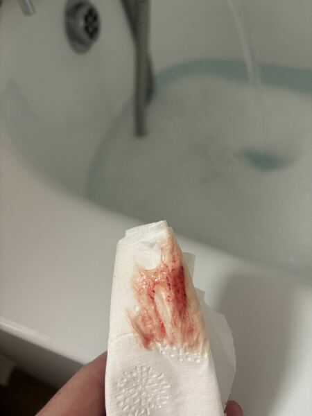 Implantation bleeding
