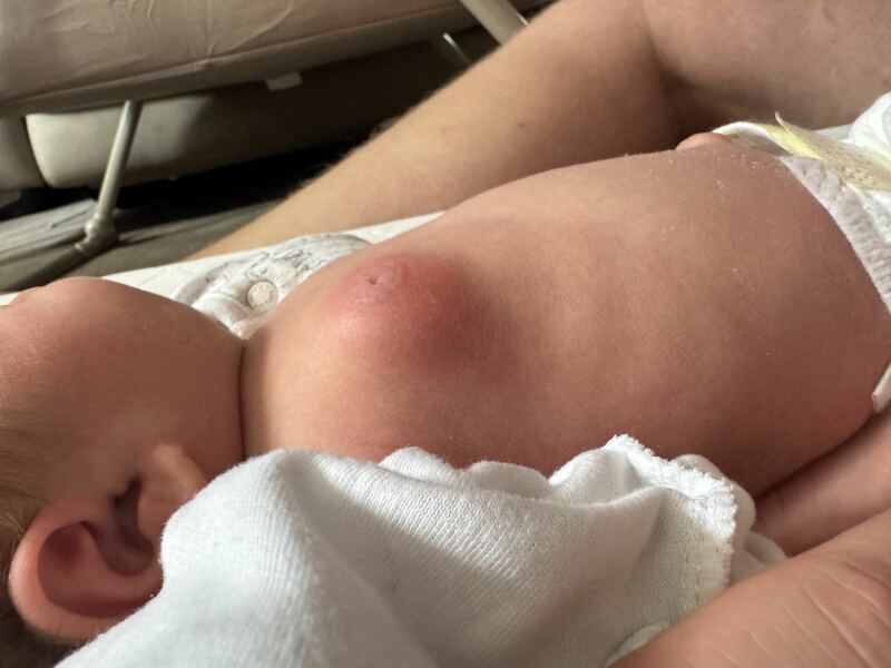 Swollen Breast in newborn