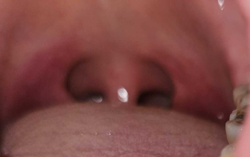 Tonsillitis??
