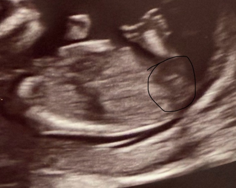 Boy or girl based on nub theory