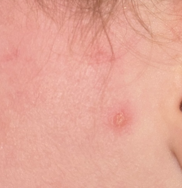To ask if this looks like the start of chicken pox?