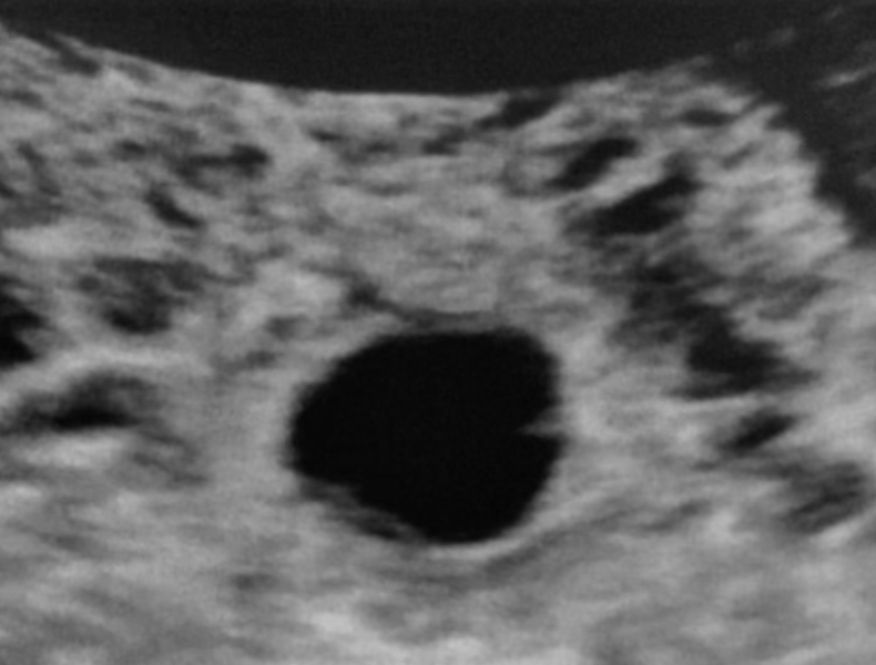 Scan confusion! 5 weeks scan