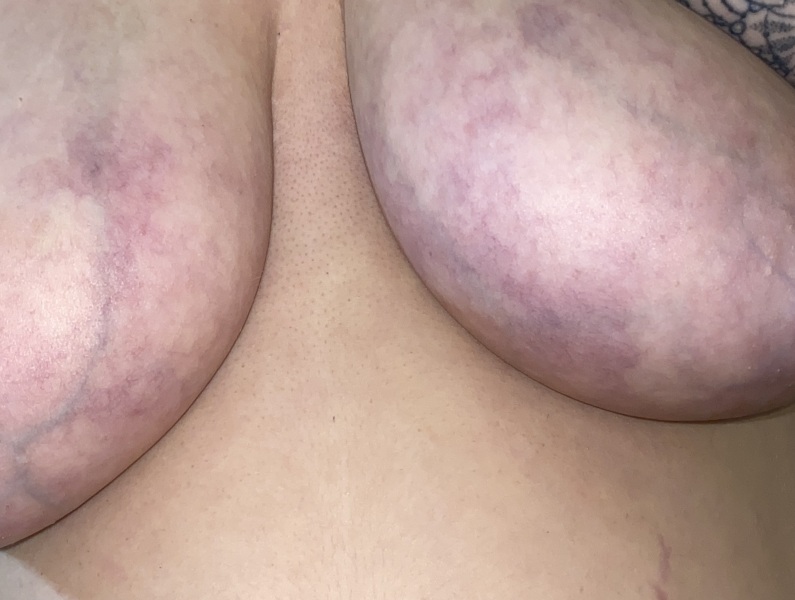 Bruising on both breasts?