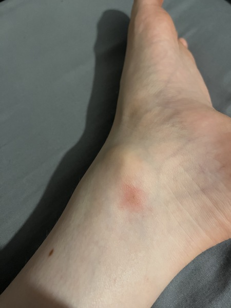 Infected insect bite?