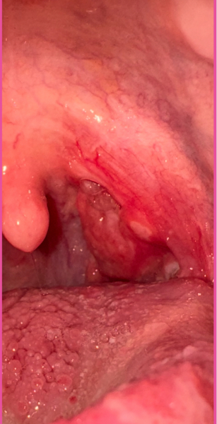 PIC IN COMMENTS. Ulcer or Tonsillitis ? Please help
