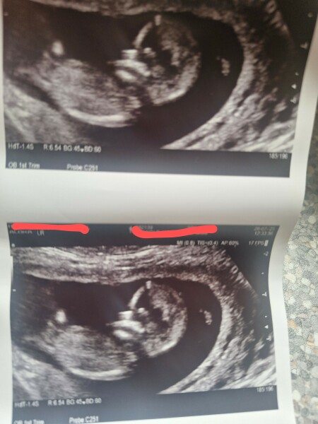 Boy or girl, nub theory!