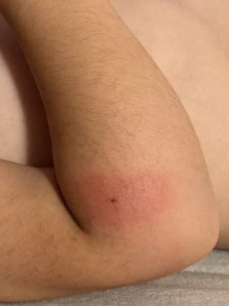 What kinda insect bite is this?