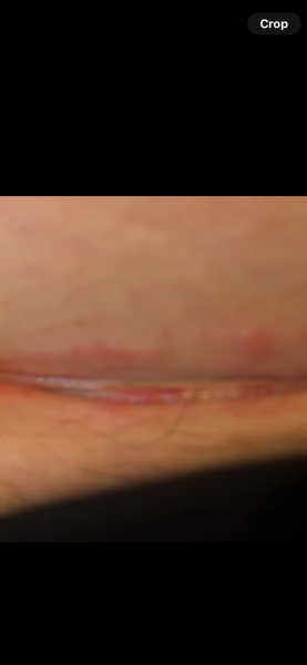 Do I need to see a doctor ? Please someone advise *[contains image of c-section scar]