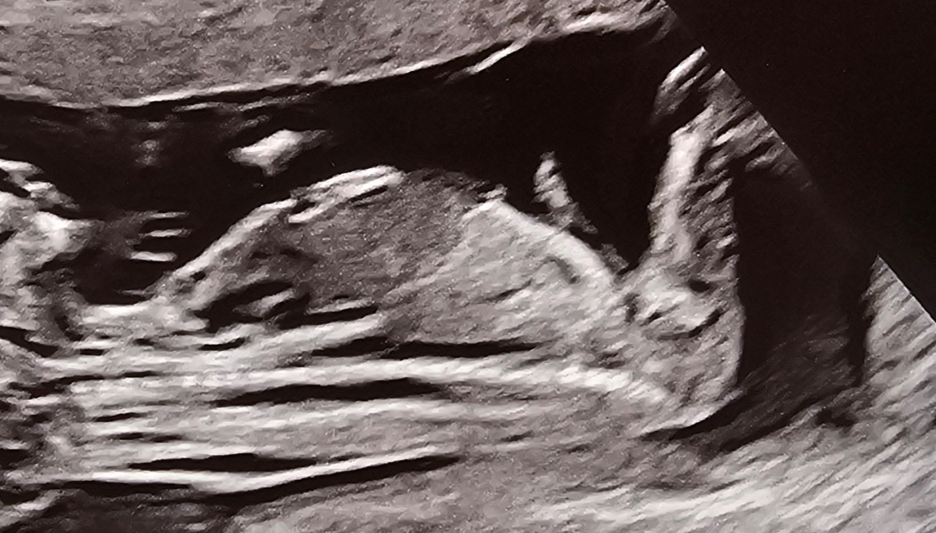 Is the gender nub visible on this scan?