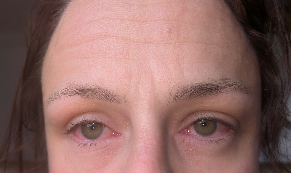 Rapidly spreading skin infection under arm. Help. (Photo warning)