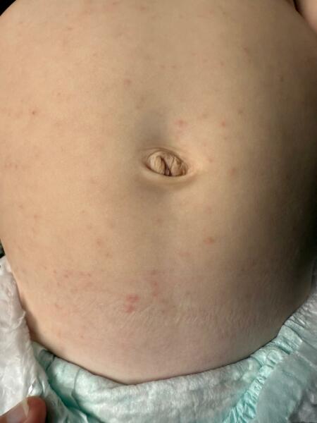 Chicken pox?