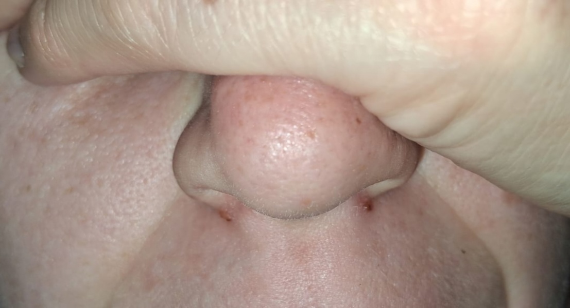 Coldsore or spots?