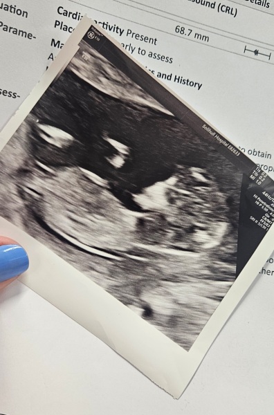 Gender predictions 13 week scan