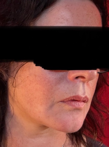 Having facelift surgery in 10 days - support and advice needed