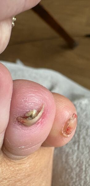Fungal toenail: wanna see?
