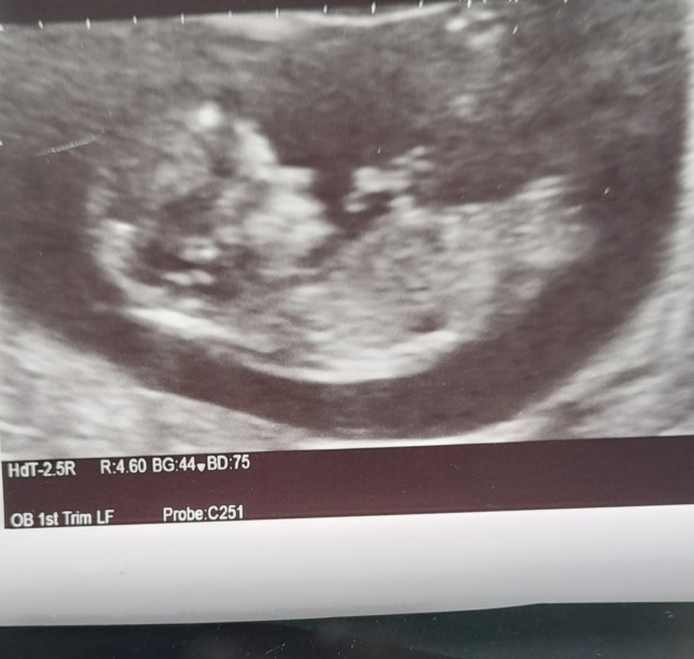 12 week scan
