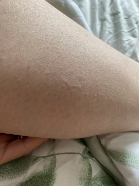 Do you want to see something *disgusting* on my leg?