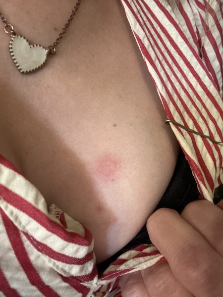 Lump appeared on breast