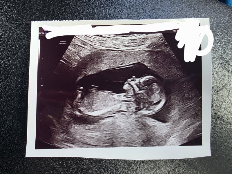 10 week scan - what's your thoughts?