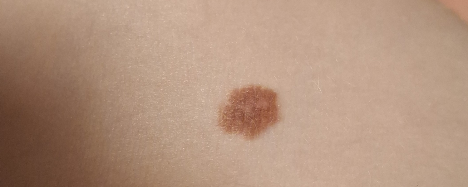 Unusual mole