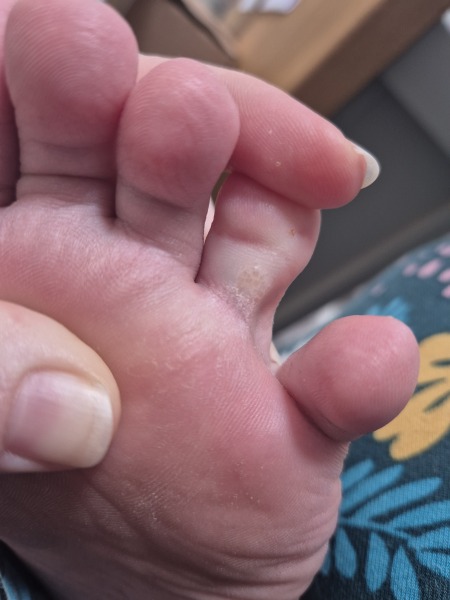 What is this weird thing on my toe?