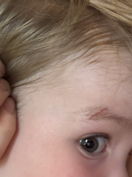 Toddler facial scarring