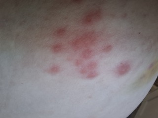 Weird burny rash