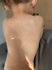 rash appeared 4 days ago on my son