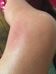 Insect bite