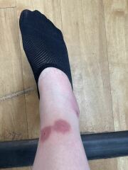 Identify my bites!