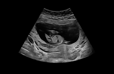Umbilical cord or boy?