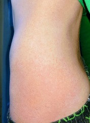 What is this rash please?