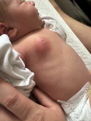 Swollen Breast in newborn