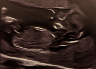 Can you guess sex from my crumpled 12wk scan