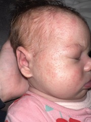 Rash/spots only on babies head and face