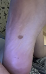 Moles / mark on sole of foot