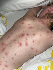 Normal chickenpox