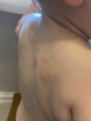 Does this look like ringworm?